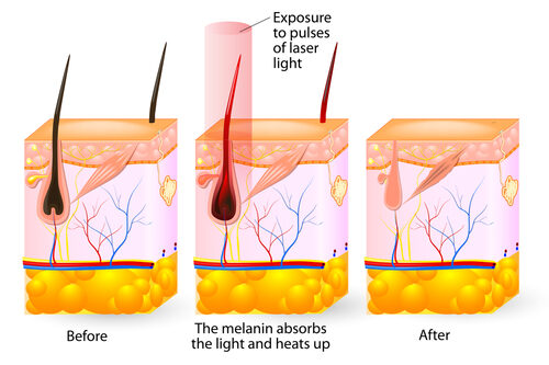 Laser,Hair,Removal.